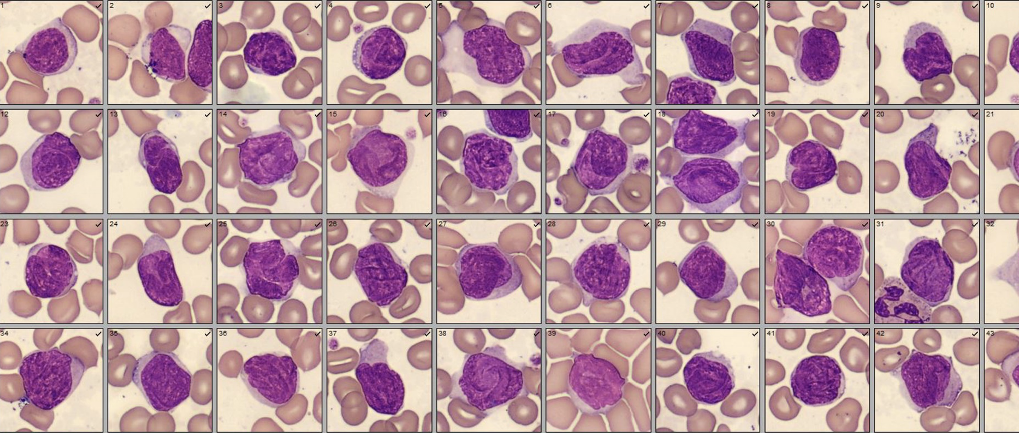 Patient case #1 - Sezary Syndrome | CellaVision